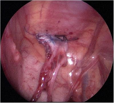 The Shehata technique for undescended testes that cannot be brought into the scrotum in one operation—a case series and meta-analysis